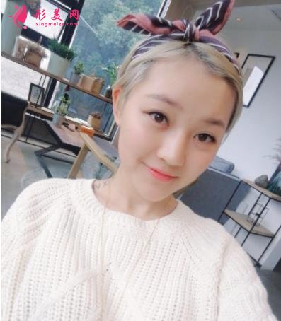 成都潤(rùn)美玉之光整形怎么樣？自體脂肪全臉填充案例和真實(shí)價(jià)格價(jià)目分享