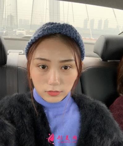鄭東美眼醫(yī)療美容怎么樣？雙眼皮案例效果反饋圖及價(jià)格費(fèi)用清單查詢
