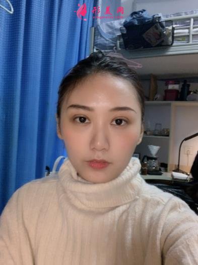 鄭東美眼醫(yī)療美容怎么樣？雙眼皮案例效果反饋圖及價(jià)格費(fèi)用清單查詢