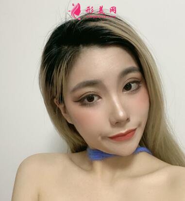 北京協(xié)和整形醫(yī)院雙眼皮案例_價格(價目)表請查收~