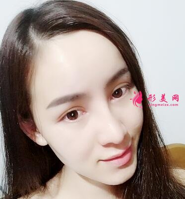 西京醫(yī)院夏文森隆鼻咋樣?醫(yī)生案例、整形價格公開
