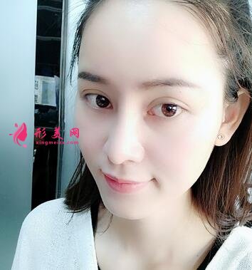 西京醫(yī)院夏文森隆鼻咋樣?醫(yī)生案例、整形價格公開