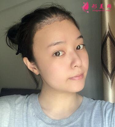 長春海峽整形醫(yī)院植發(fā)咋樣？案例效果_價格收費(fèi)表請查收~
