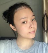 長春海峽整形醫(yī)院植發(fā)咋樣？案例效果_價格收費表請查收~