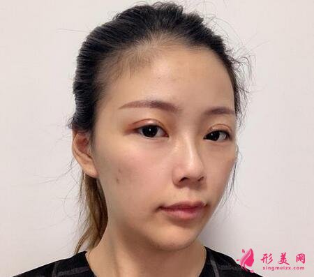 合肥中山醫(yī)院整形科雙眼皮案例反饋！價(jià)格價(jià)目表收費(fèi)明細(xì)公開(kāi)~