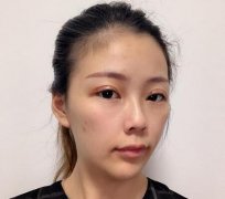 合肥中山醫(yī)院整形科雙眼皮案例反饋！價(jià)格價(jià)目表收費(fèi)明細(xì)