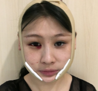 佛山禪城中心醫(yī)院整形磨骨咋樣？案例效果反饋_整形價(jià)格同步一覽