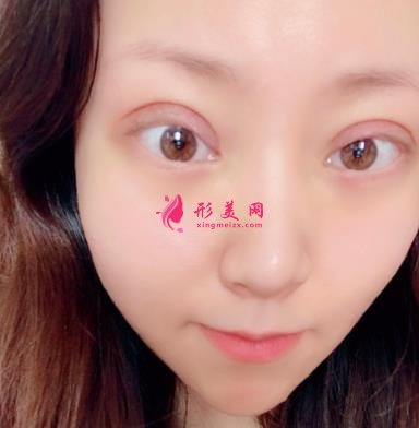 天津公安醫(yī)院雙眼皮怎么樣？手術(shù)恢復過程分享_價格在線查詢