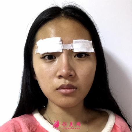 北京協(xié)和醫(yī)院雙眼皮多少錢？真人效果術(shù)后圖、價格表清單一一公布！