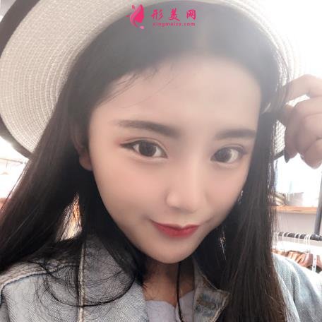 北京協(xié)和醫(yī)院雙眼皮多少錢？真人效果術(shù)后圖、價格表清單一一公布！