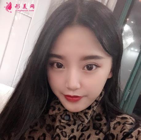 北京協(xié)和醫(yī)院雙眼皮多少錢？真人效果術(shù)后圖、價格表清單一一公布！