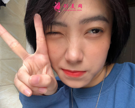 遵義醫(yī)學(xué)院整形外科雙眼皮案例口碑評價(jià)出爐！全新醫(yī)美價(jià)格表供參考~