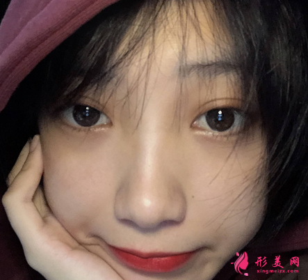 遵義醫(yī)學(xué)院整形外科雙眼皮案例口碑評價(jià)出爐！全新醫(yī)美價(jià)格表供參考~