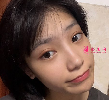 遵義醫(yī)學(xué)院整形外科雙眼皮案例口碑評價(jià)出爐！全新醫(yī)美價(jià)格表供參考~