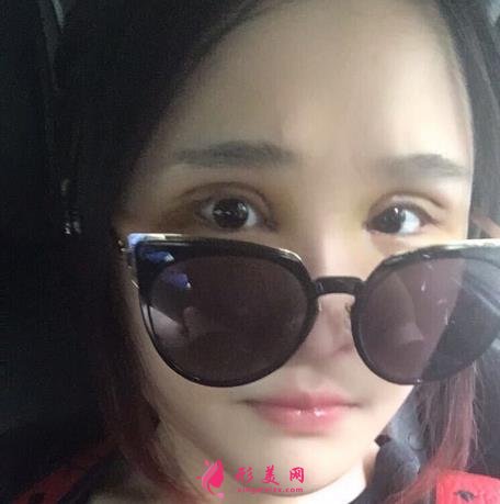 華西整形醫(yī)院做雙眼皮好不好？看專家案例和價(jià)格表為你們揭曉！