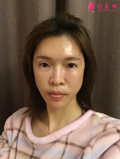 北京協(xié)和醫(yī)院脂肪填充做得好嗎？王陽醫(yī)生案例和價格表紛紛上線！