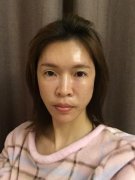 北京協(xié)和醫(yī)院脂肪填充做得好嗎？王陽(yáng)醫(yī)生案例和價(jià)格表紛紛上線！