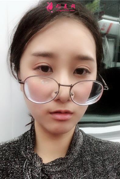 無錫曼陀羅醫(yī)院上臉下垂矯正案例_整形美容價格表請查收！