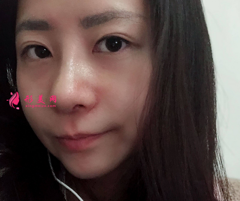 深圳美萊整形美容醫(yī)院隆鼻案例反饋如下~還有價(jià)格收費(fèi)表明細(xì)參考
