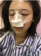 佛山華美整形醫(yī)院隆鼻做的咋樣？案例效果價(jià)格（價(jià)目）表供參考