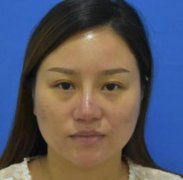 南昌大學(xué)二附院整形科去眼袋怎么樣？對(duì)比下真人案例及價(jià)格均價(jià)表