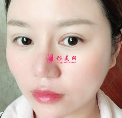 南昌大學(xué)二附院整形科去眼袋怎么樣？對(duì)比下真人案例及價(jià)格均價(jià)表