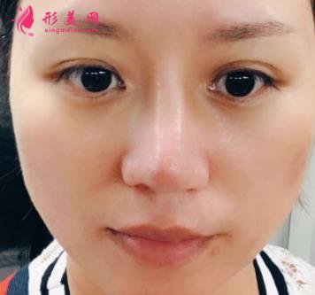 南昌大學(xué)二附院整形科去眼袋怎么樣？對(duì)比下真人案例及價(jià)格均價(jià)表