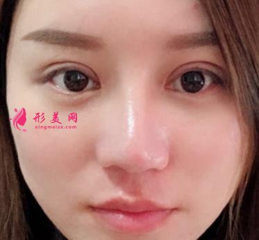南昌大學(xué)二附院整形科去眼袋怎么樣？對(duì)比下真人案例及價(jià)格均價(jià)表