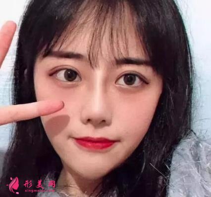 常州一院整形科做鼻子價(jià)格表2021！在分享真實(shí)案例效果圖