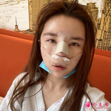 寧波六院隆鼻怎么樣？手術多少錢？真實恢復效果圖分享