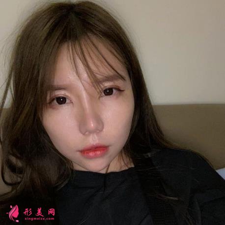 寧波六院隆鼻怎么樣？手術多少錢？真實恢復效果圖分享