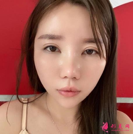 寧波六院隆鼻怎么樣？手術多少錢？真實恢復效果圖分享