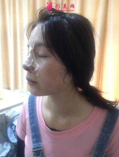 2021上海九院戴傳昌做鼻子價格表!在對比真人隆鼻案例實拍