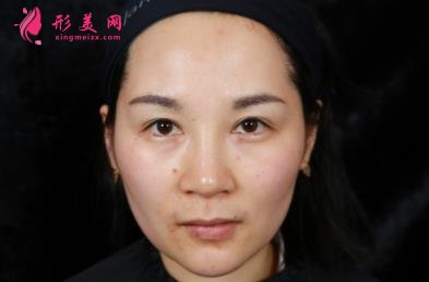 四川華西醫(yī)院整形科玻尿酸豐太陽穴案例查詢！含2022全新價(jià)格表公