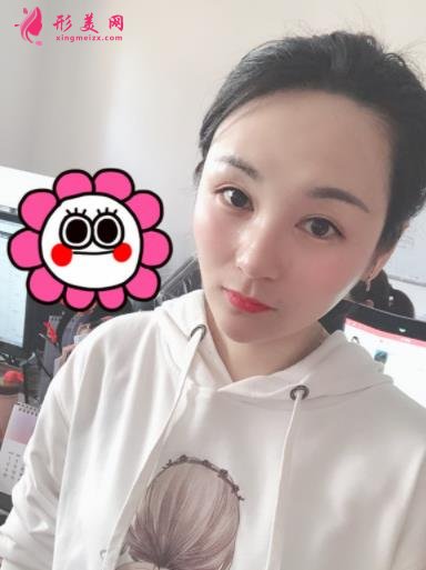 四川華西醫(yī)院整形科玻尿酸豐太陽穴案例查詢！含2022全新價(jià)格表公