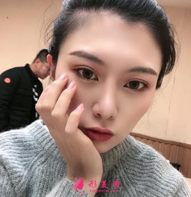 深圳陽光整形醫(yī)院雙眼皮怎么樣？效果好嗎？手術(shù)真實(shí)價(jià)格費(fèi)用參考