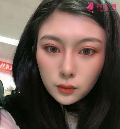 深圳陽光整形醫(yī)院雙眼皮怎么樣？效果好嗎？手術(shù)真實(shí)價(jià)格費(fèi)用參考