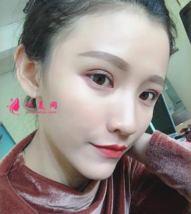 徐州醫(yī)院雙眼皮做得好嗎？眼部整形案例及價格情況詳細(xì)公示
