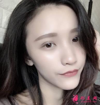 徐州醫(yī)院雙眼皮做得好嗎？眼部整形案例及價格情況詳細(xì)公示