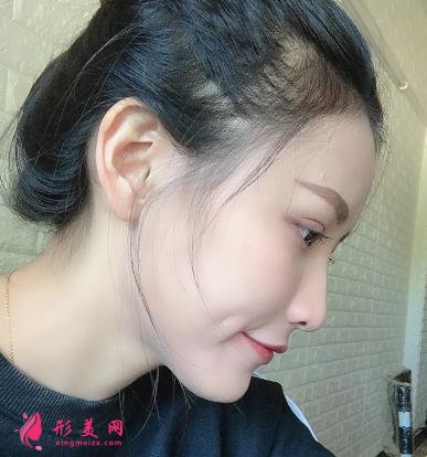 徐州醫(yī)院雙眼皮做得好嗎？眼部整形案例及價格情況詳細(xì)公示