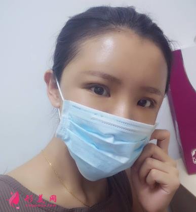 徐州醫(yī)院雙眼皮做得好嗎？眼部整形案例及價格情況詳細(xì)公示