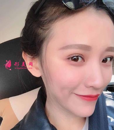 徐州醫(yī)院雙眼皮做得好嗎？眼部整形案例及價格情況詳細(xì)公示