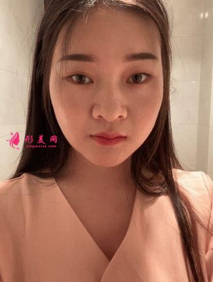 西安國際醫(yī)學中心整形醫(yī)院怎么樣？下頜角削骨案例及價格表2021均價一覽