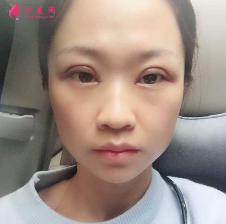 深圳北大醫(yī)院整形科做雙眼皮怎么樣？案例及價(jià)格表（多少錢）在線參考