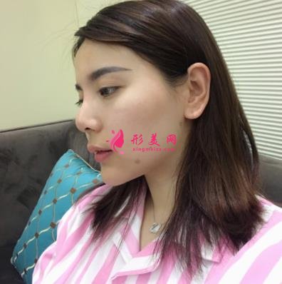 上海長(zhǎng)征醫(yī)院整形科面部吸脂怎么樣？術(shù)后瘦臉效果跟美顏相機(jī)說(shuō)再見(jiàn)！