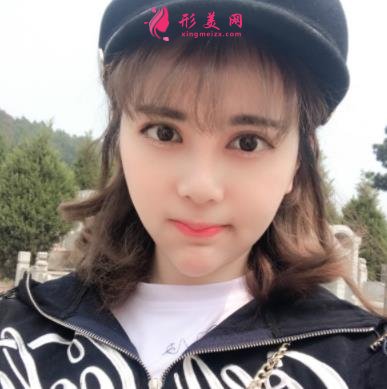上海長(zhǎng)征醫(yī)院整形科面部吸脂怎么樣？術(shù)后瘦臉效果跟美顏相機(jī)說(shuō)再見(jiàn)！