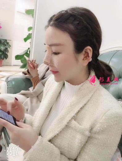 南京康美馮思陽隆鼻怎么樣？看完下面真實(shí)案例及價格收費(fèi)表再來評價