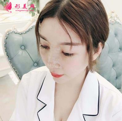 南京康美馮思陽隆鼻怎么樣？看完下面真實(shí)案例及價格收費(fèi)表再來評價