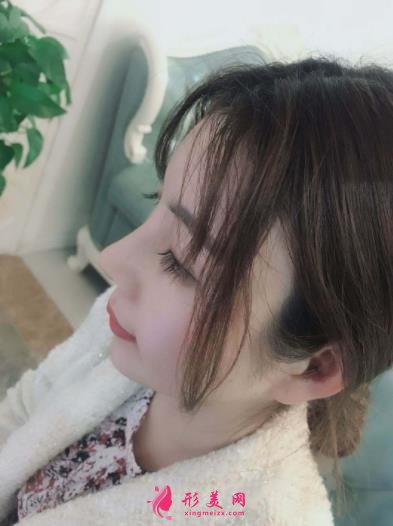 南京康美馮思陽隆鼻怎么樣？看完下面真實(shí)案例及價格收費(fèi)表再來評價