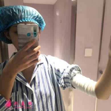 河北工程大學(xué)附屬醫(yī)院整形外科手臂抽脂案例分享！含吸脂價格表公開